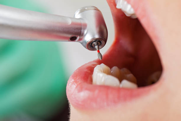 Best Emergency Dentist for Lost Fillings or Crowns in Imperial, CA